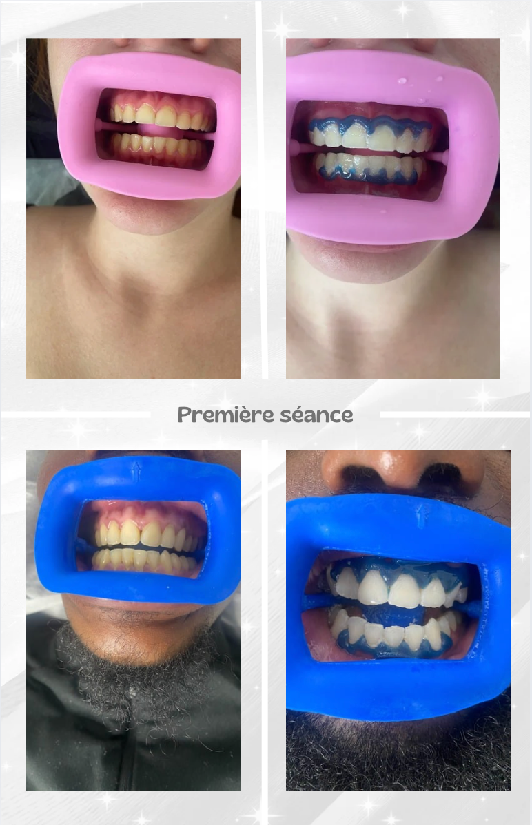 Teeth Whitening Training